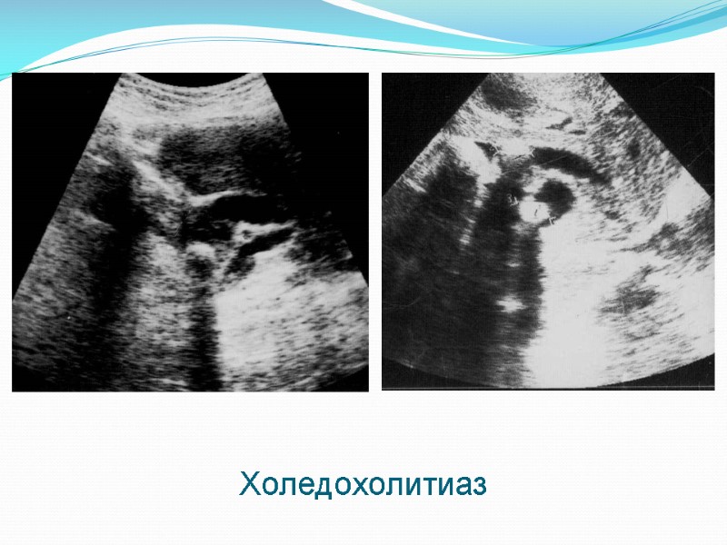 Холедохолитиаз